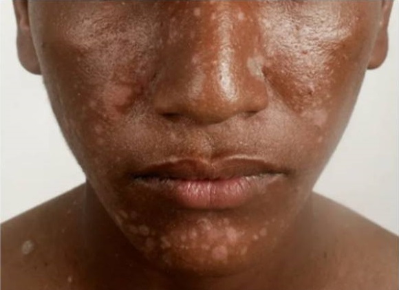 5-common-skin-diseases-in-africa